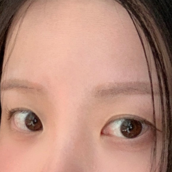 Before Frown Line Botox Side Effects treatment – straight eyebrows with no arch