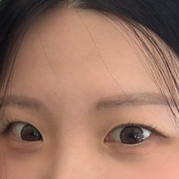 Close-up of frown lines before Botox procedure at VandS Clinic