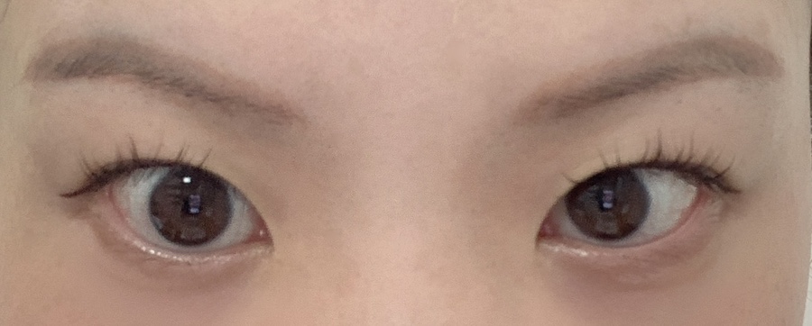 After one week of Frown Line Botox Side Effects – uneven samurai eyebrow effect