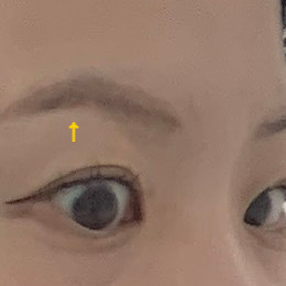 When raising eyebrows, one side appears higher after Botox