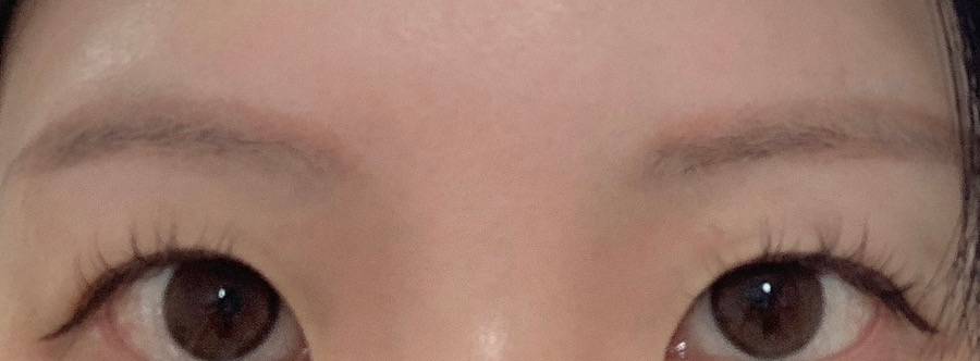 Eyebrow shape back to normal after Botox correction