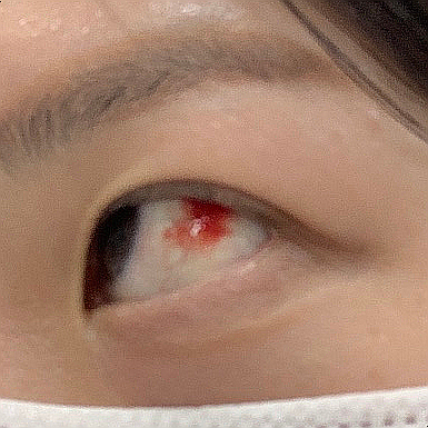 Side view of subconjunctival hemorrhage while wearing a mask, no symptoms present