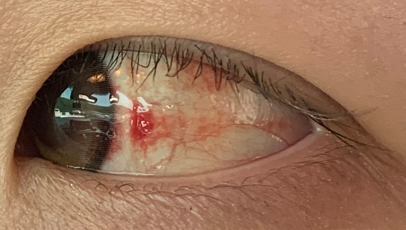 Inner corner subconjunctival hemorrhage close-up view