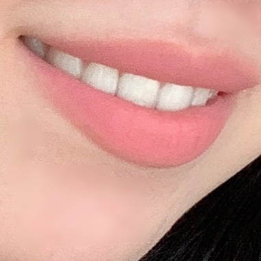 Teeth shaving after photo showing a subtle and natural smile result