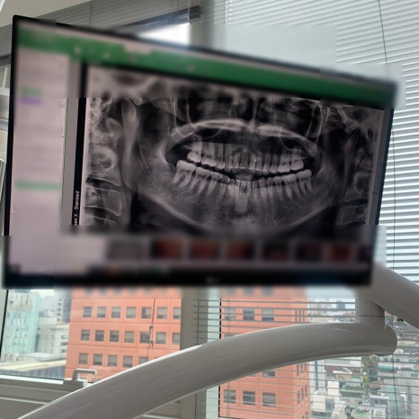 Panoramic dental x-ray before teeth shaving before and after in Korea